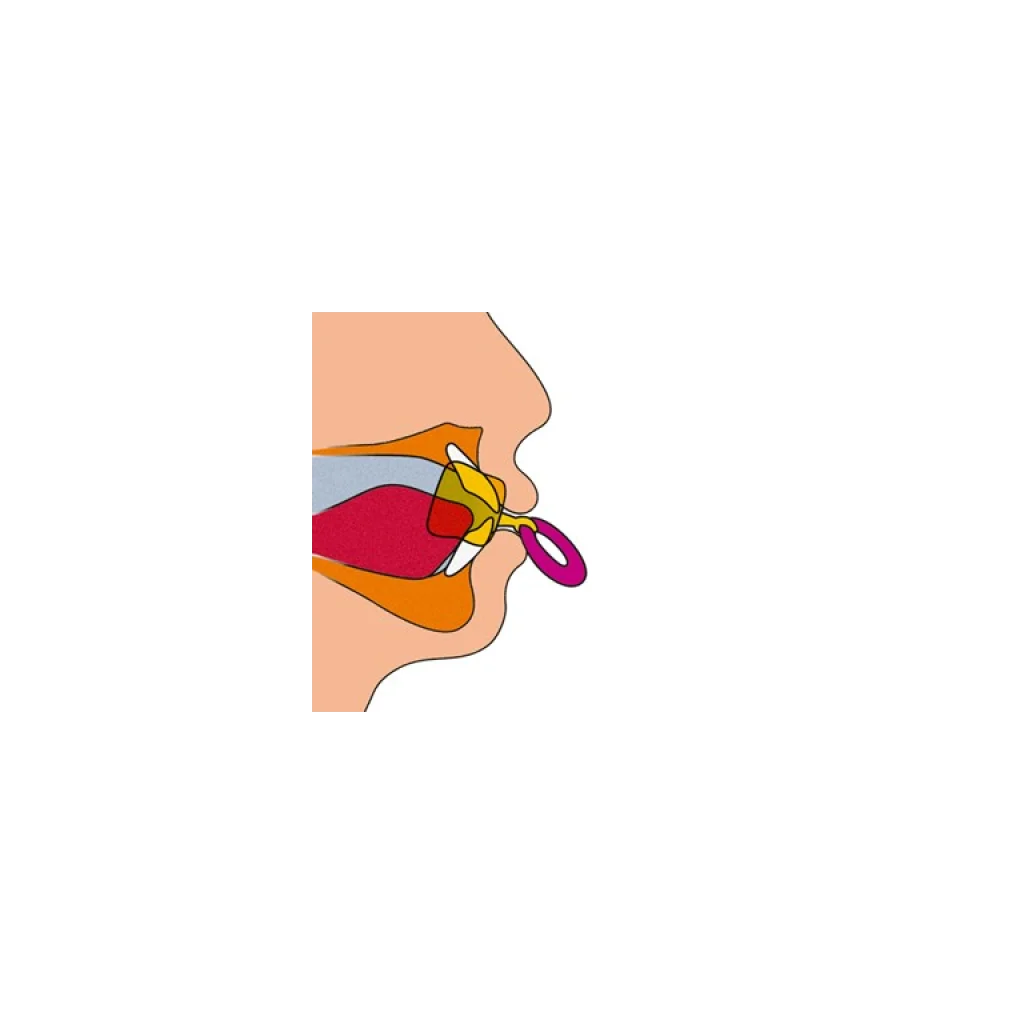 Child with Muppy oral vestibular plate – Supports natural teeth alignment