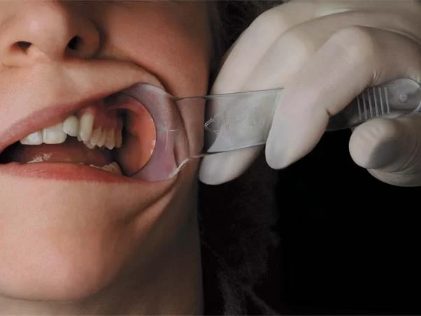 Wangenhalter-myofunktionelleTherapie-myofunktionelle Störung-Logopädie